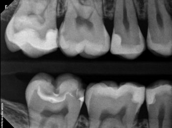 digital x-ray of top and bottom teeth