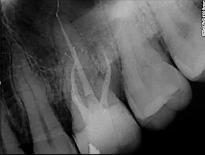 digital x-ray of the roots of a tooth